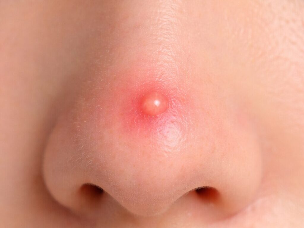 鼻子痘痘感染致命